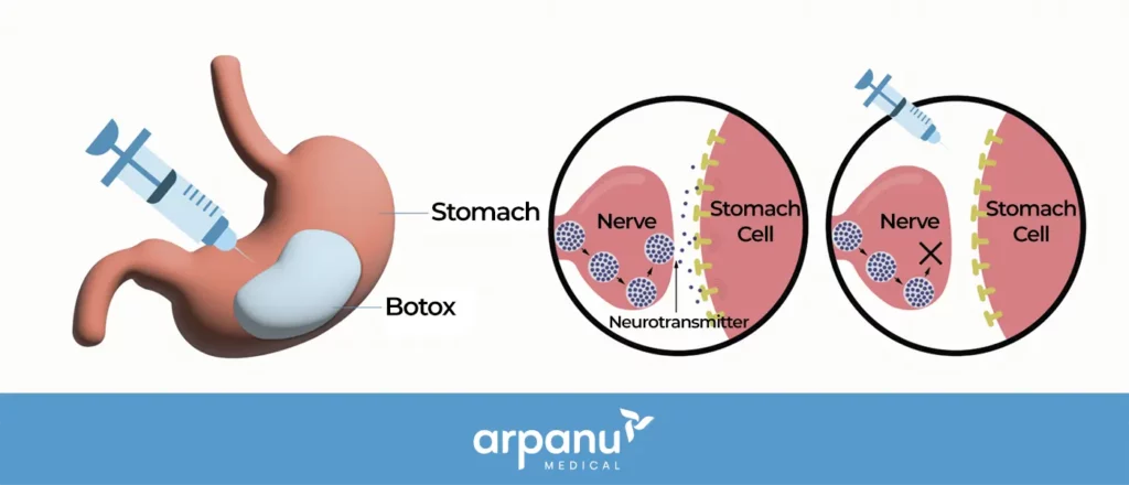 An Illustration Of Stomach Botox Details