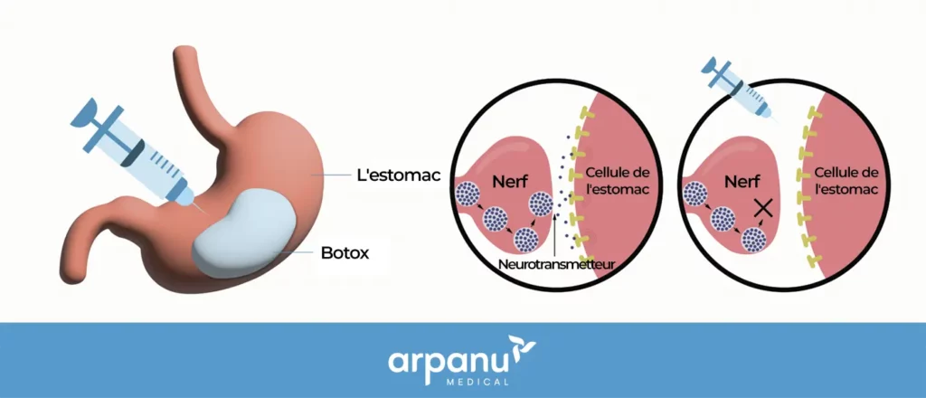 Stomach Botox Detail- Fr