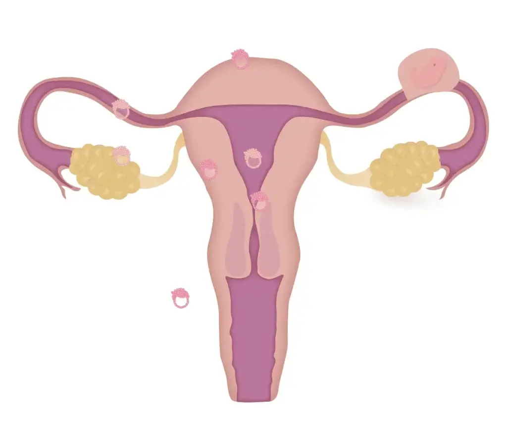 Ectopic Pregnancy And Ivf