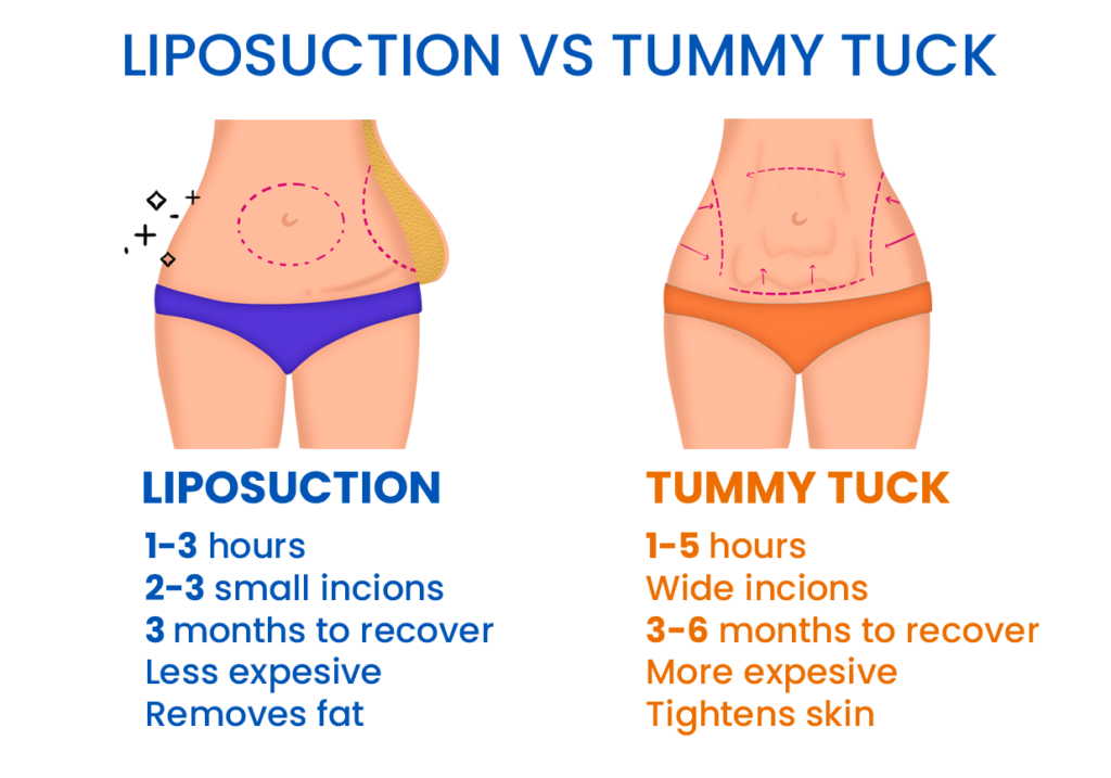 Liposuction Vs Tummy Tuck Comparison