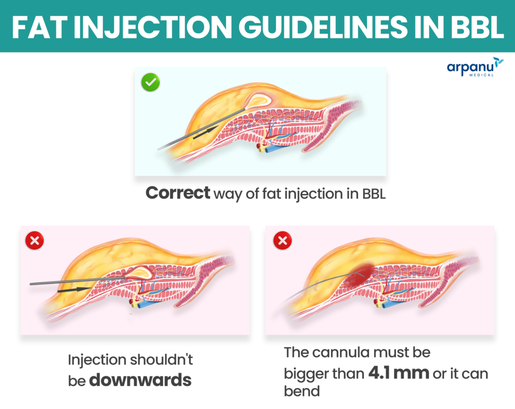 Bbl Fat Injection, Bbl Injection, Bbl Guideline, Bbl Risks, Bbl Death, Bbl Death Rate