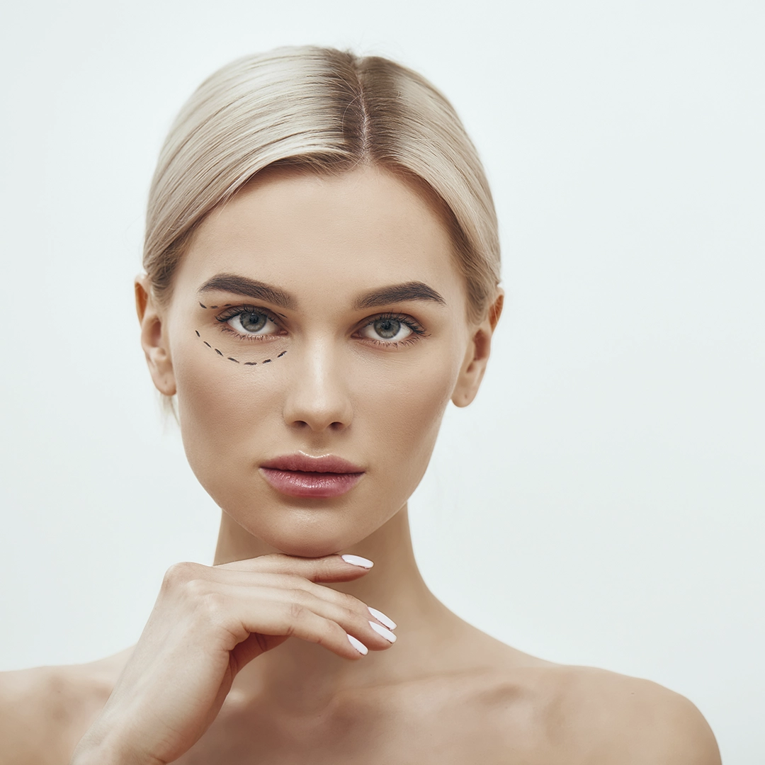 A Woman Abouut To Get Eyelid Surgery Also Known As Blepharoplasty