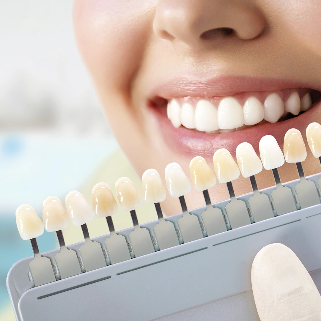 Dental Veneers