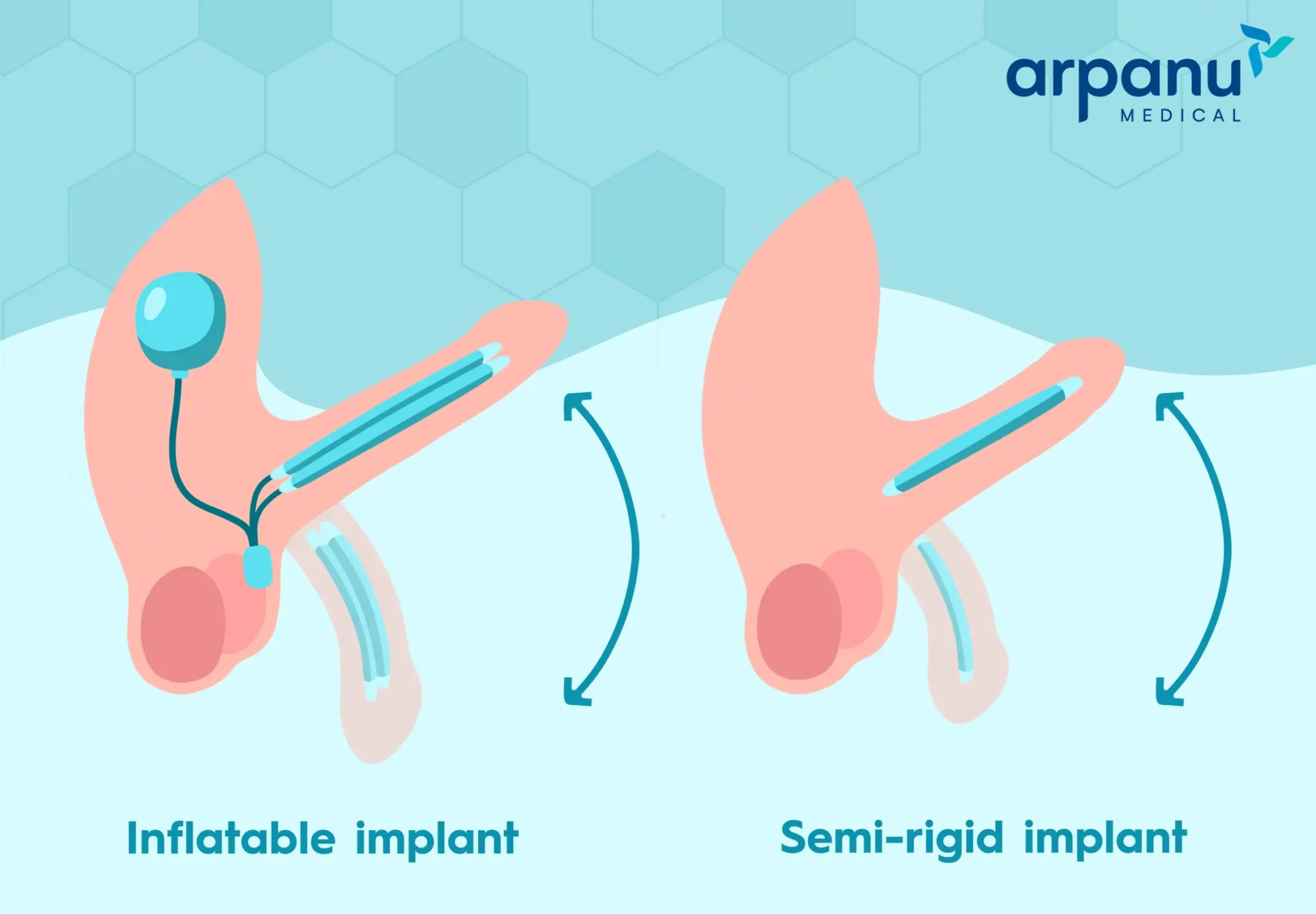 Penile Implant In Turkey
