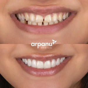 veneers before after photo