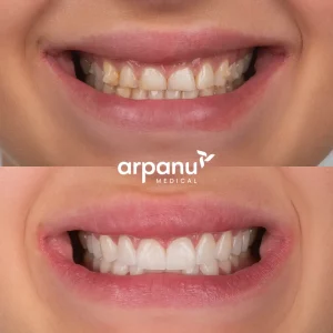 veneers before after photo