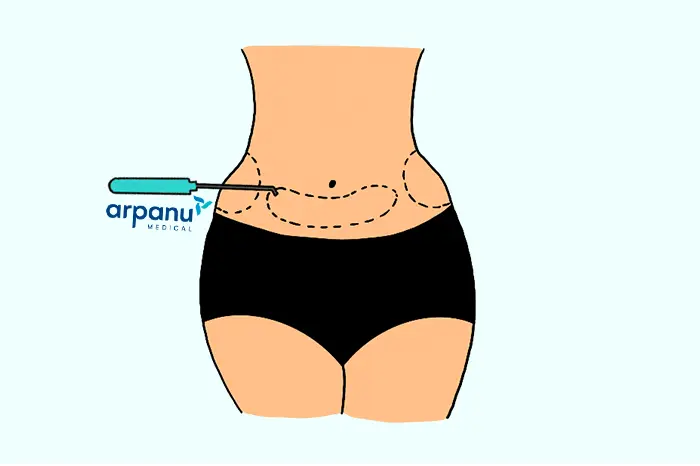 An Infographic Of A Bbl Fat Extraction