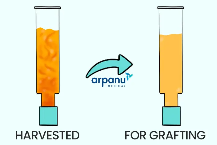 An Infographic Of A Bbl Fat Purification