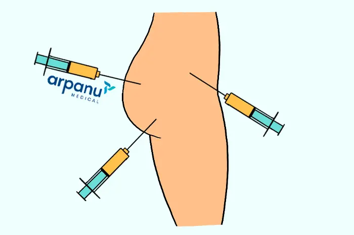 An Infographic Of A Bbl Fat Injection