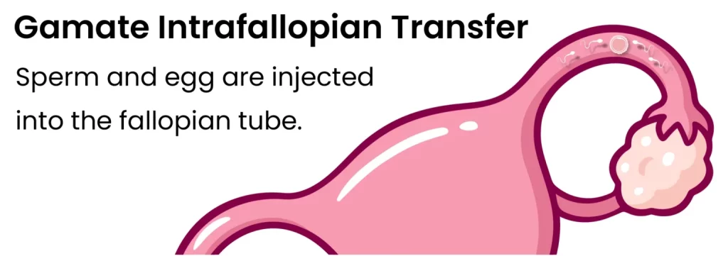 An Infographic Of Gamete Intrafallopian Transfer