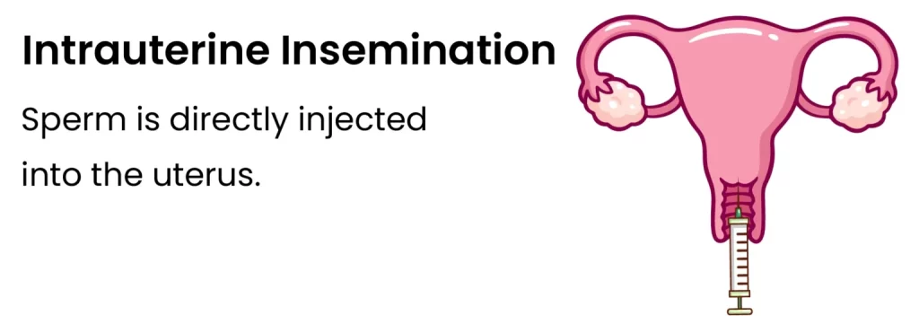 An Infographic Of Intrauterine Insemination Iui