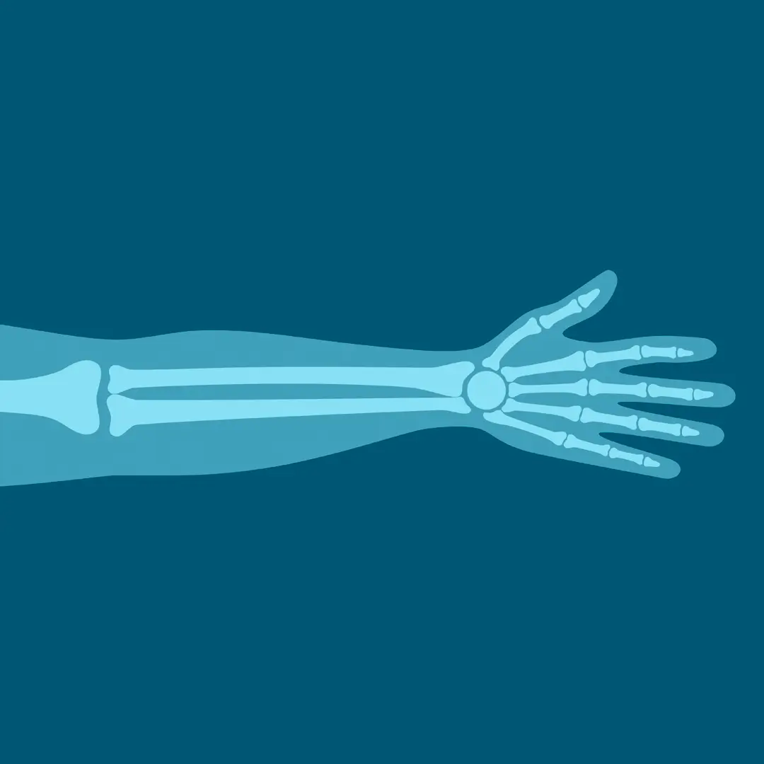 An Illustration Of The Skeletal Anatomy Of The Arm, Resembling An X-Ray
