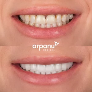 veneers before after photo
