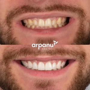 veneers before after photo