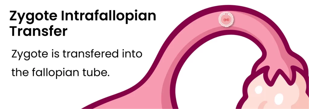An Infographic Of Zygote Introfallopian Transfer