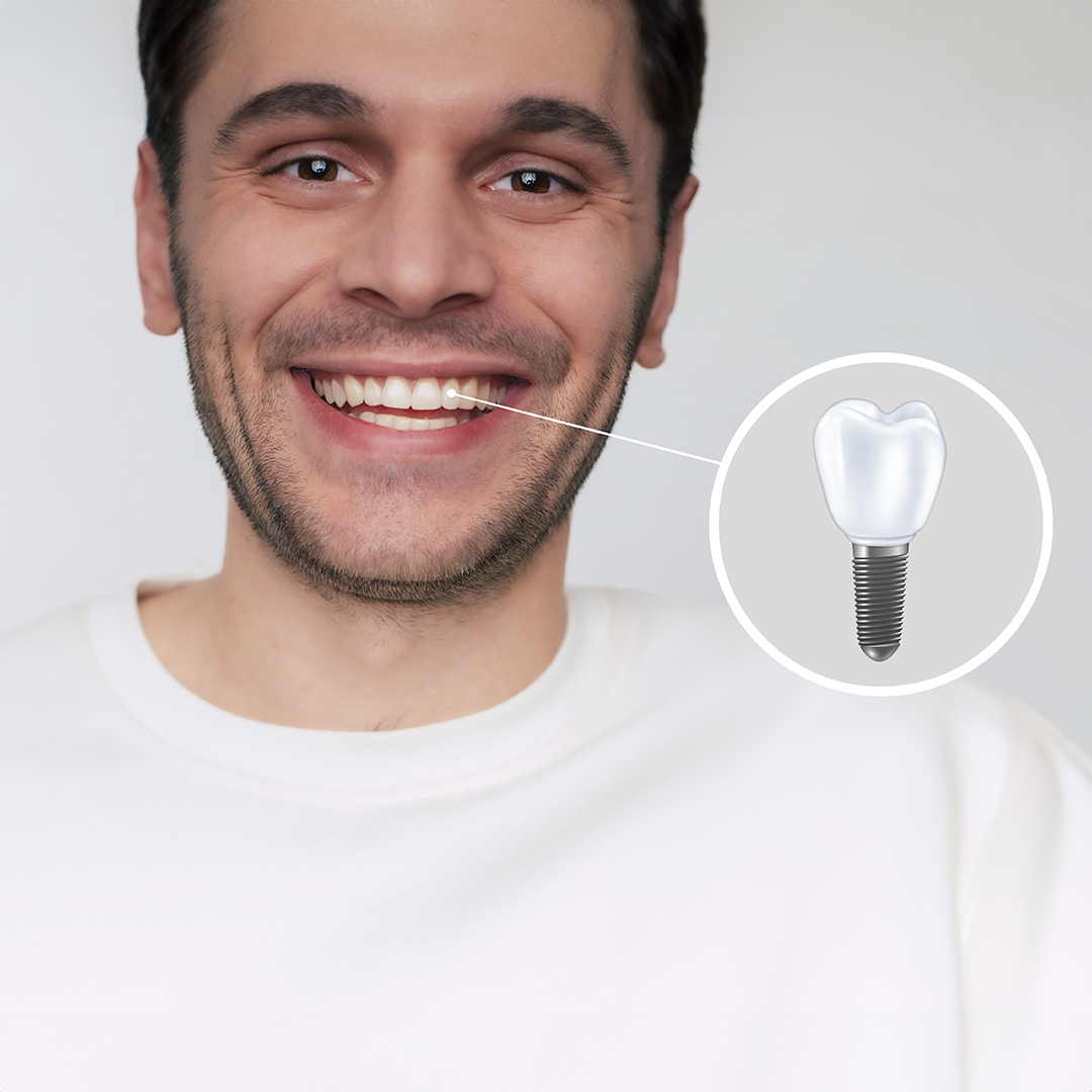 Dental Implant Candidate