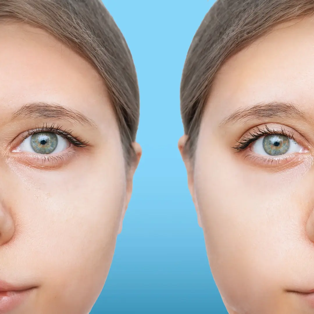 Youthful Eyes With Blepharoplasty