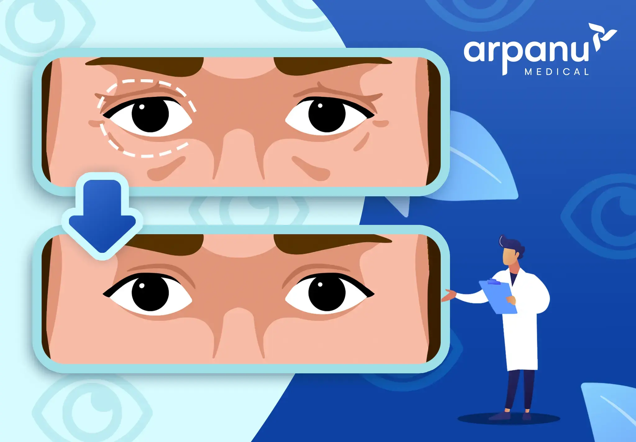 Blepharoplasty Infog 1