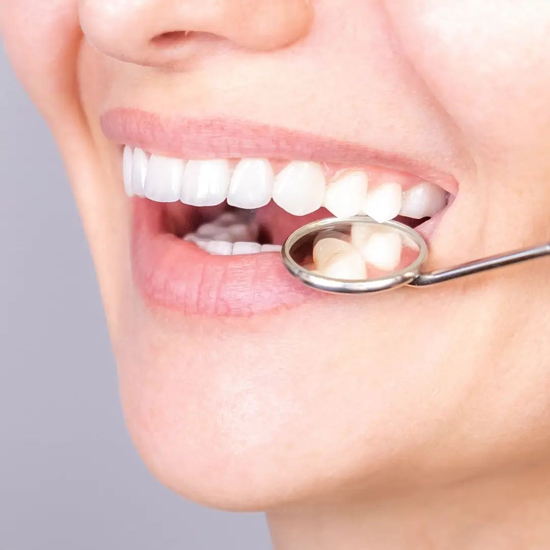 Stainless Steel Crowns