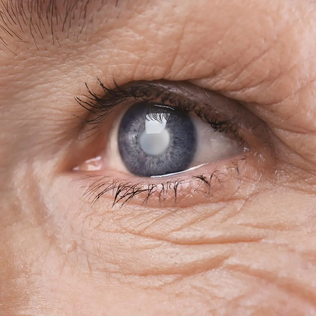 Lens Replacement In Turkey