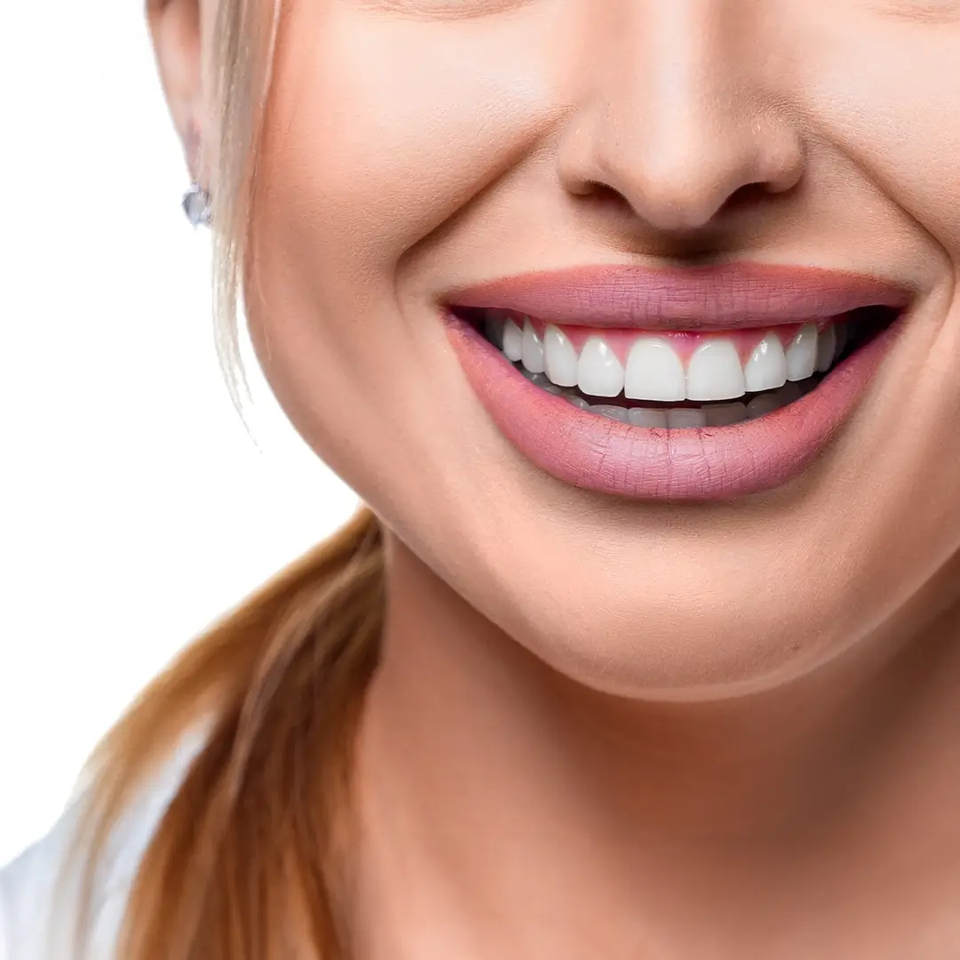 Teeth-Whitening-In-Turkey (4)