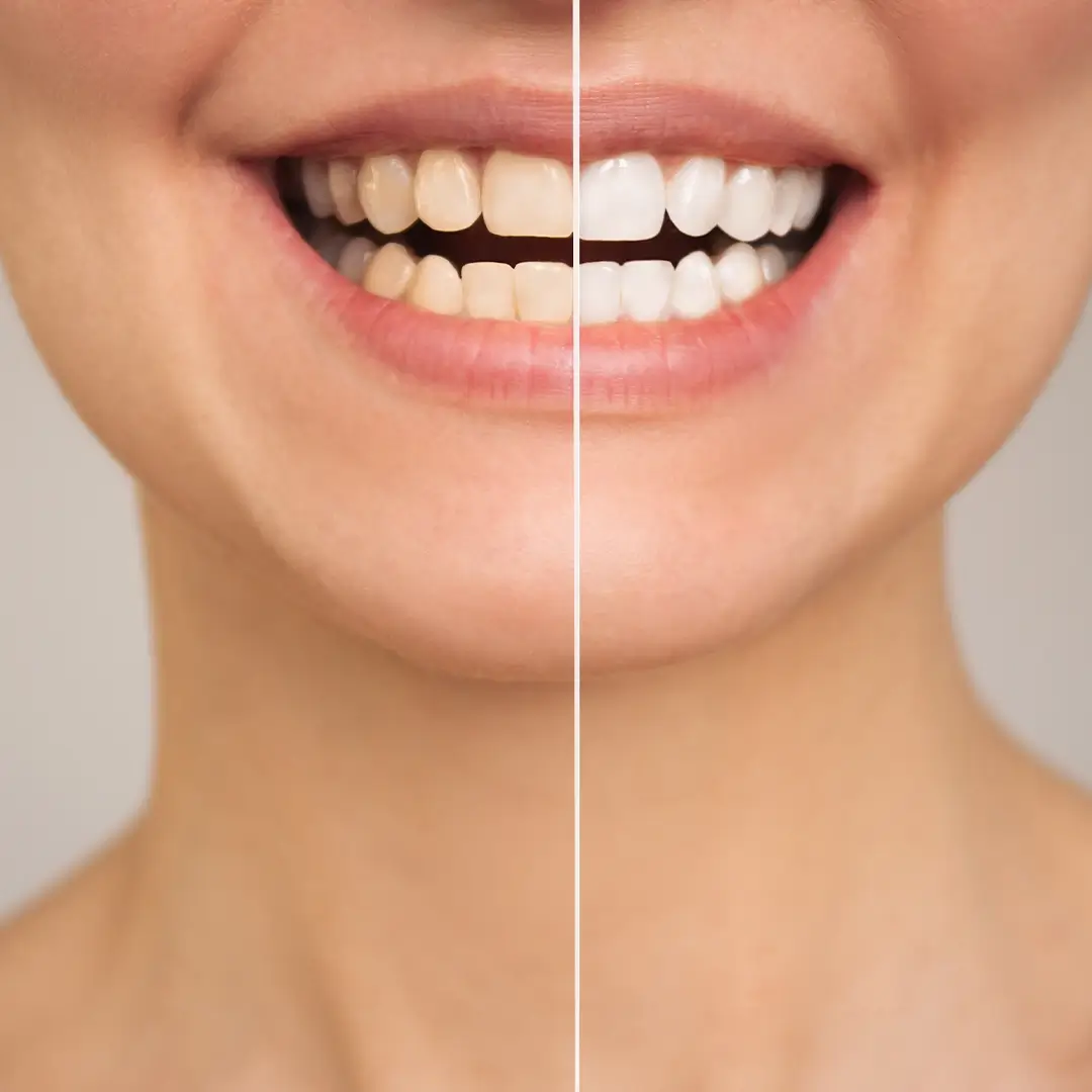 An Image Of A Face Divided In Two Symmetrical Parts, With One Half Showing Stained Teeth And The Other Half With White Teeth