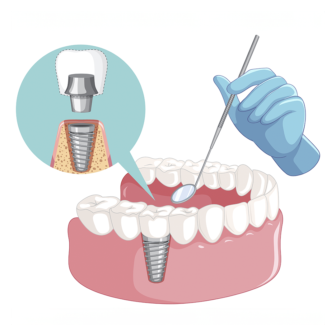 Dental Implant In Turkey Procedure