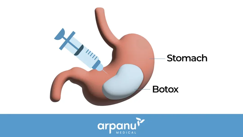 An Illustration Of Botulinum Toxin Being Injected Into The Stomach