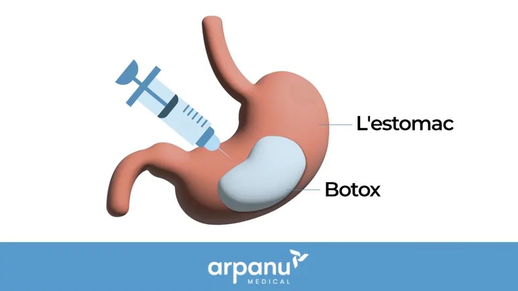 Stomach Botox - Fr