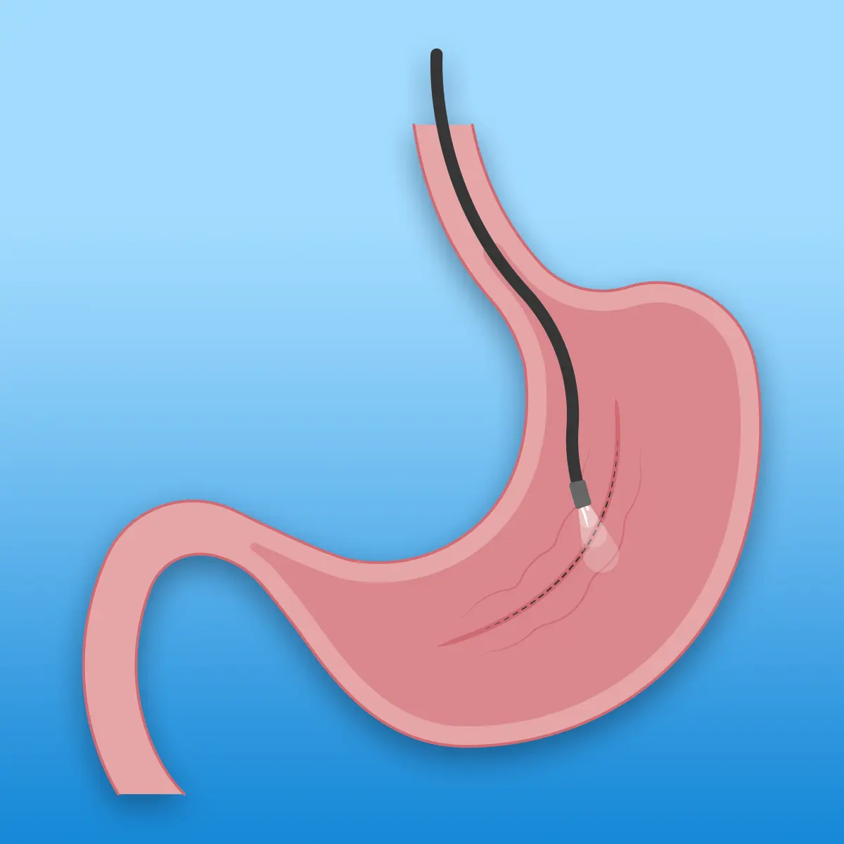 Endoscopic Sleeve