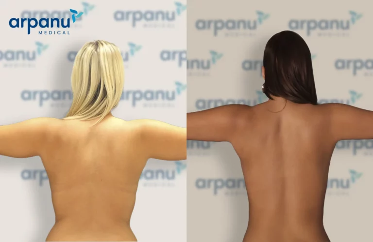 Liposuction-1