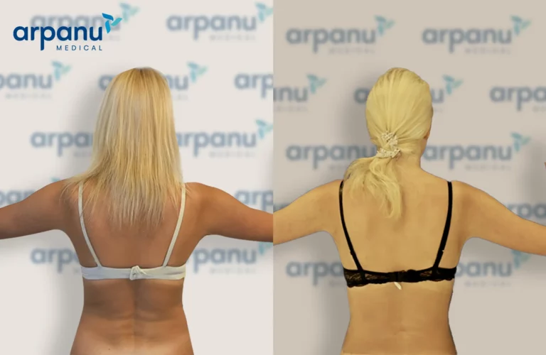 Liposuction-2