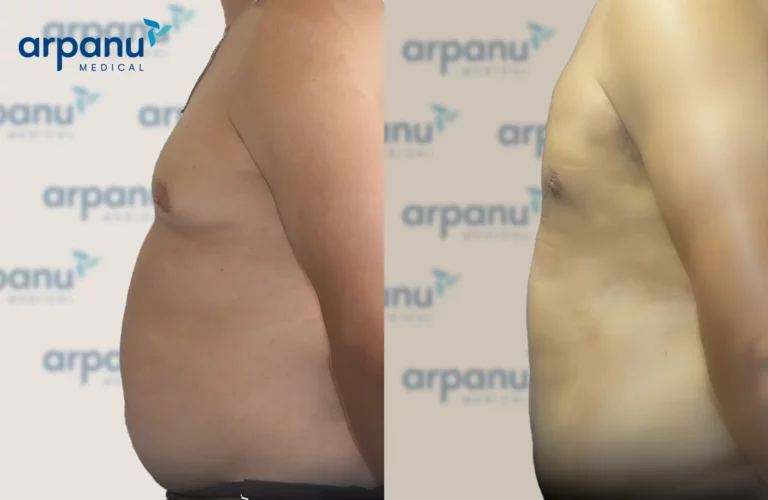 Liposuction-3