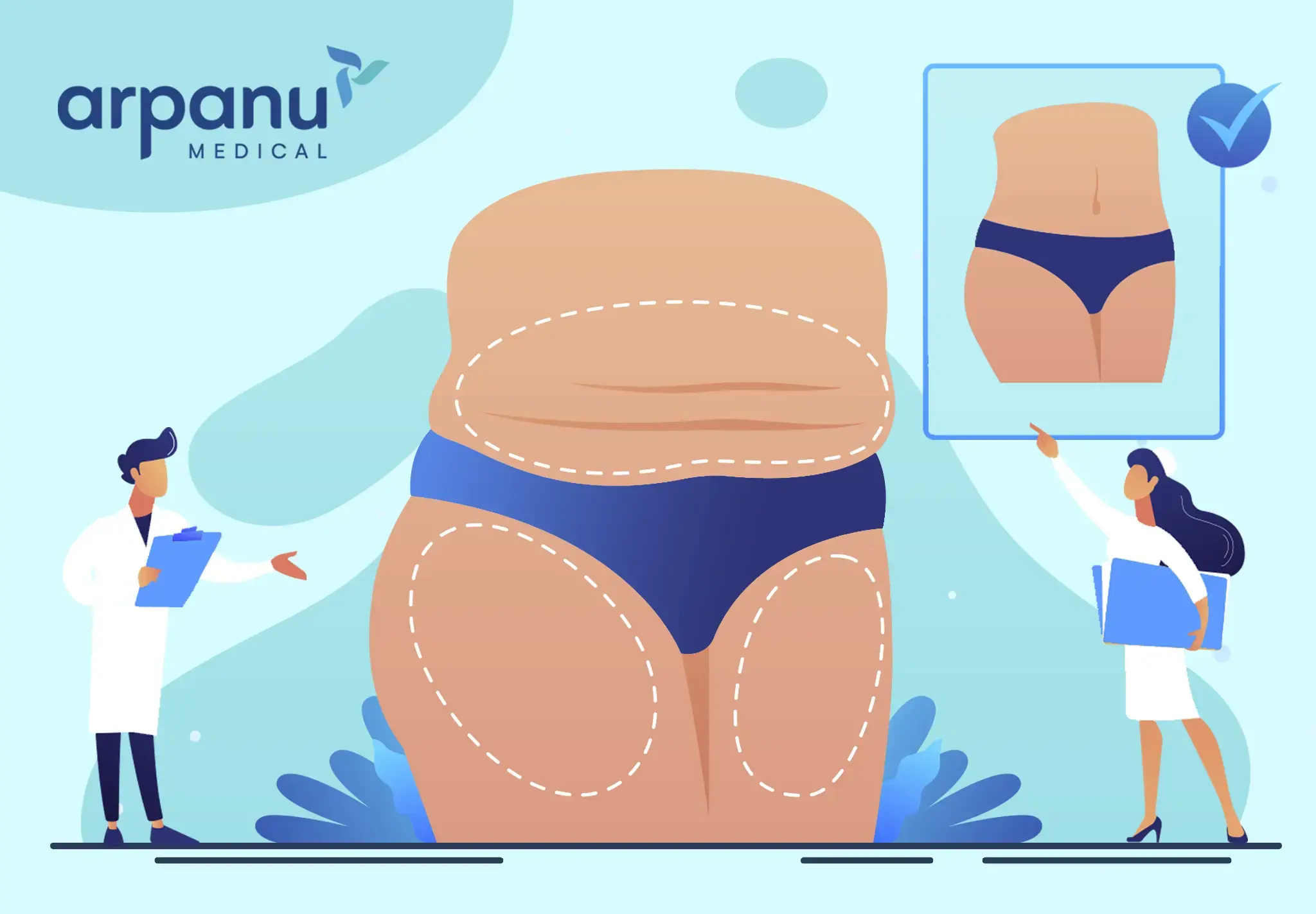 Liposuction Infog