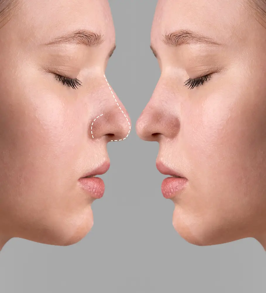 A Woman With Rhinoplasty Drawings On The Nose