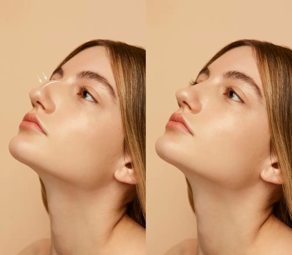 A Woman Showing Her Rhinoplasty Results